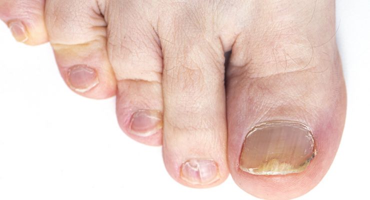 Get Rid of Yellow Toenails For Good With These 4 Natural Remedies